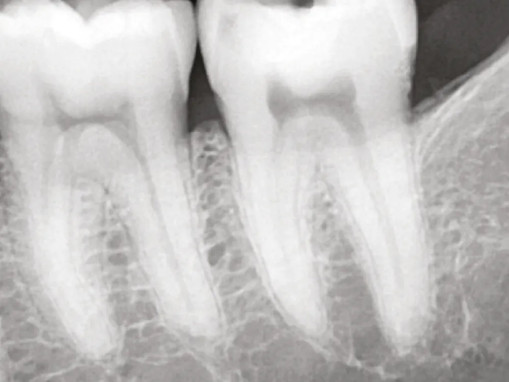 cas-onefilputtyinjectable-1 cas-onefilputtyinjectable-1