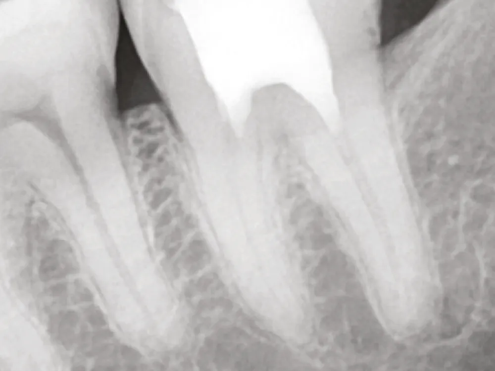 cas-onefilputtyinjectable-3 cas-onefilputtyinjectable-3