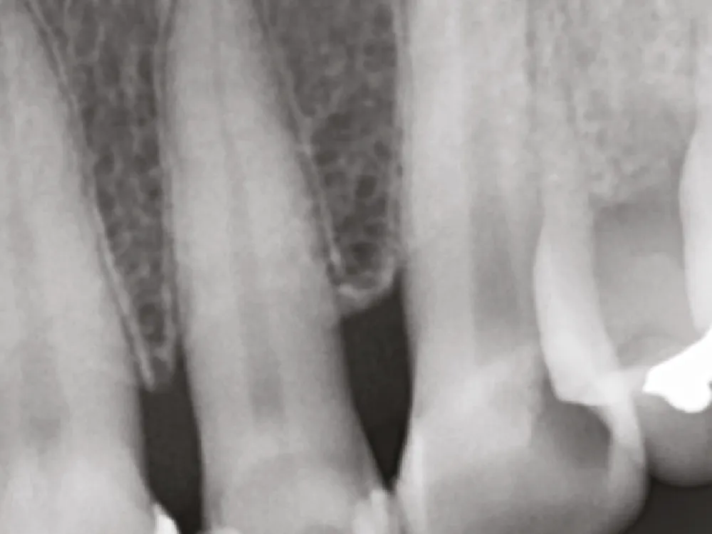 cas-onefilputtyinjectable-4 cas-onefilputtyinjectable-4