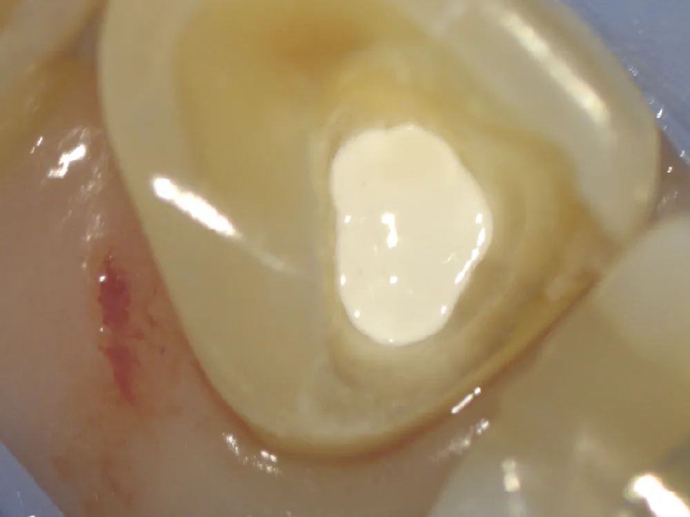 cas-onefilputtyinjectable-5 cas-onefilputtyinjectable-5